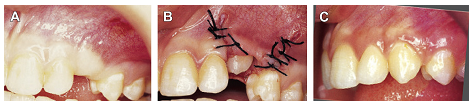 Operasi exposure gigi impaksi untuk mempermudah pertumbuhan gigi taring