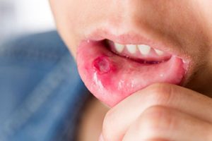 perbedaan sariawan kanker lidah