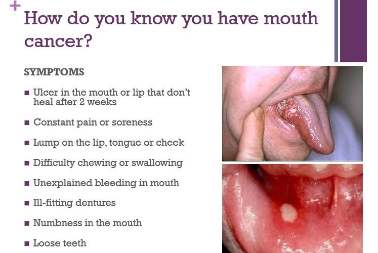 perbedaan sariawan kanker lidah