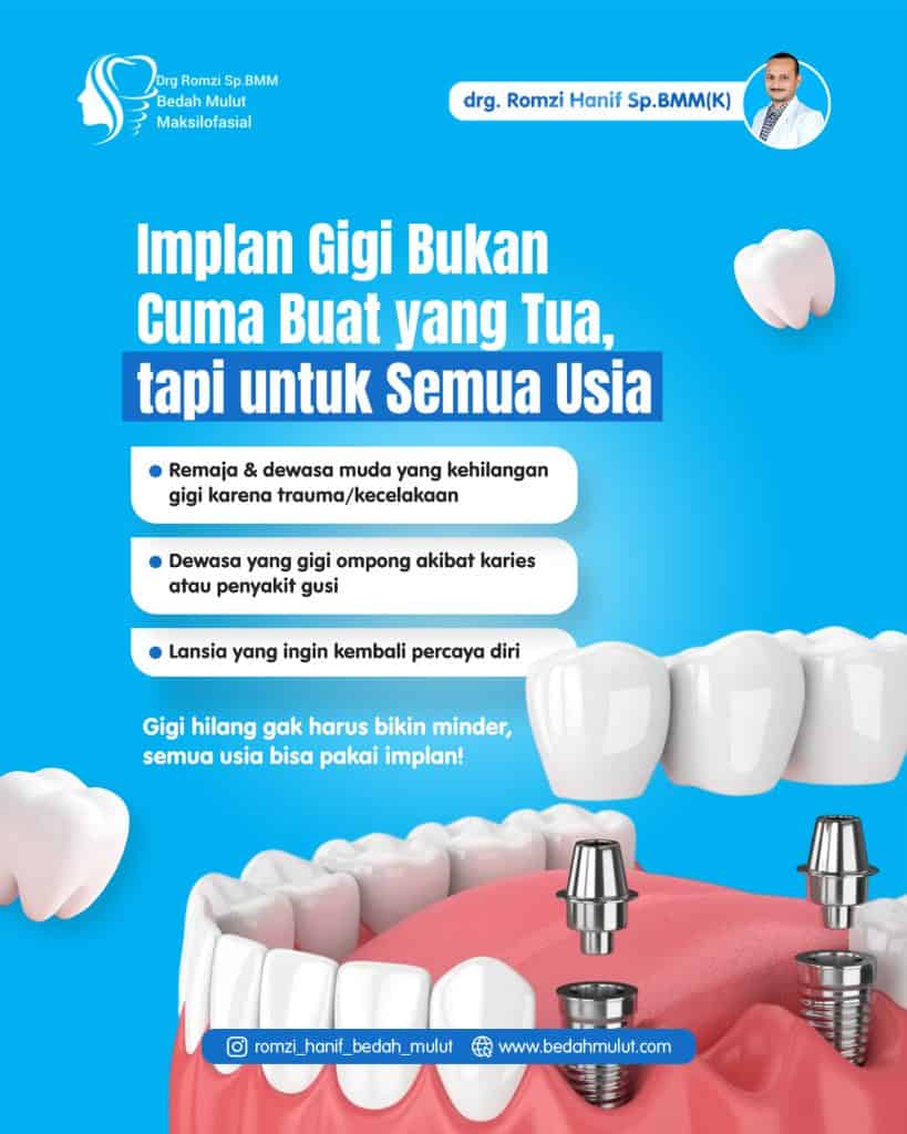 Implan bukan hanya soal estetika, tapi juga soal fungsi, kesehatan mulut, dan kepercayaan diri.