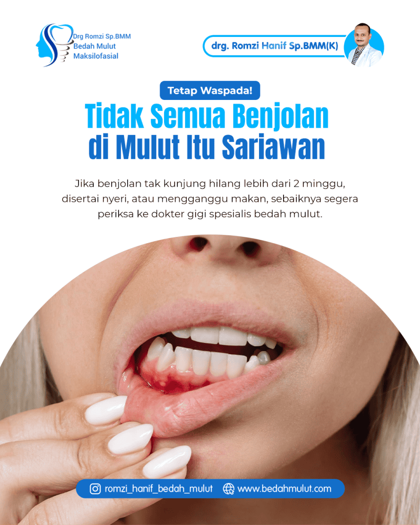 Tidak Semua Benjolan di Mulut Itu Sariawan: Panduan Lengkap Mengenali Tanda Bahaya